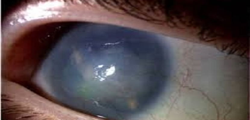 دراسة : اكتشاف أمراض العين من نمط متابعة التلفزيون