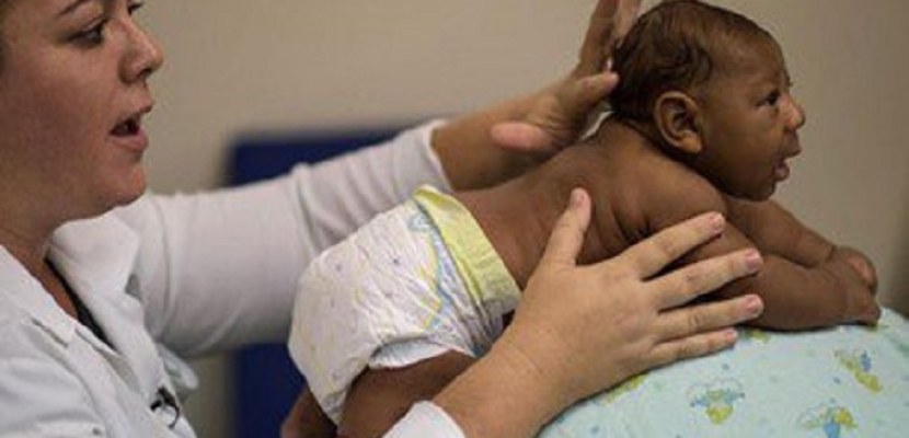 مولد أول رضيع مصاب بصغر حجم الرأس بسبب فيروس زيكا فى نيويورك