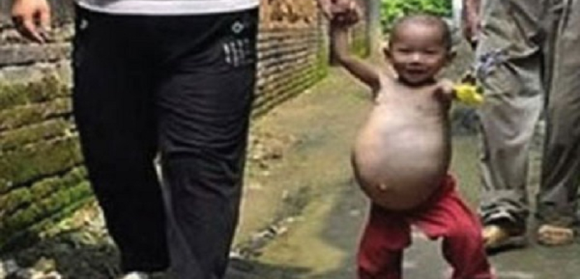 طفل صينى عمره عامان يحمل أخاه التوأم في معدته