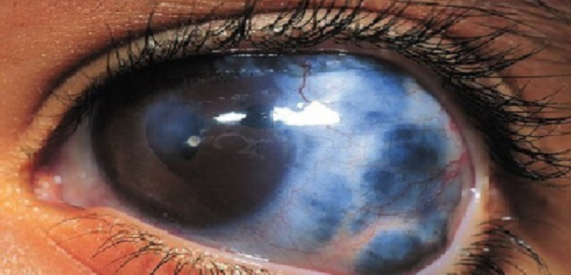 الجلوكوما.. المسبب الثاني للعمى في العالم
