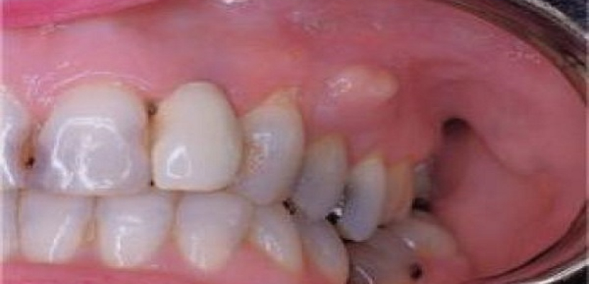 مشاكل الأسنان واللثة مؤشر إلى مرض أخطر