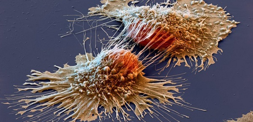 علماء: السرطان يظهر نتيجة خلل في توازن البروتين داخل الخلايا