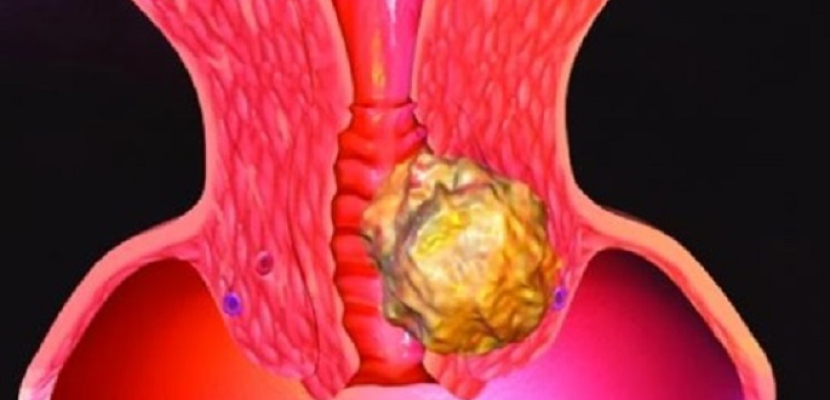 منظار الجيب .. تقنية لتشخيص حالات سرطان عنق الرحم