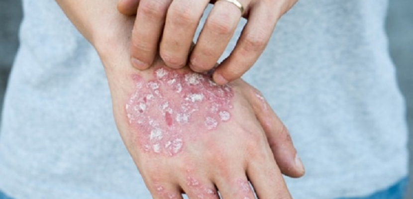 تطوير “سبراى” يحتوى على بكتيريا حية لعلاج الأكزيما الجلدية
