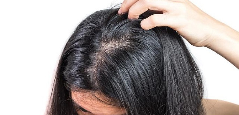 وصفات طبيعية لعلاج فراغات شعر الرأس