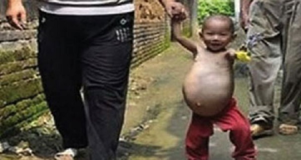طفل صينى عمره عامان يحمل أخاه التوأم في معدته