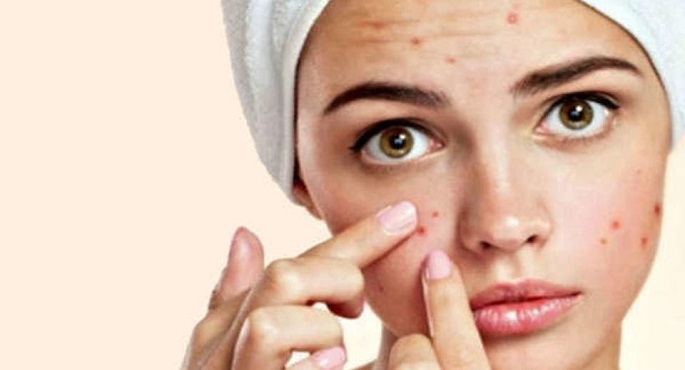 5 وصفات طبيعية لعلاج حب الشباب.. حلى المشكلة من جذورها