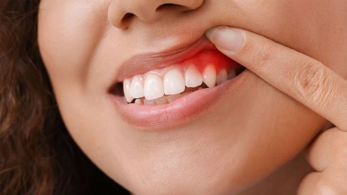 التهاب اللثة قد يعرضك لخطر الإصابة بنوبة قلبية