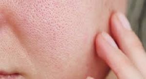 وصفات طبيعية لعلاج مشكلة المسام المفتوحة