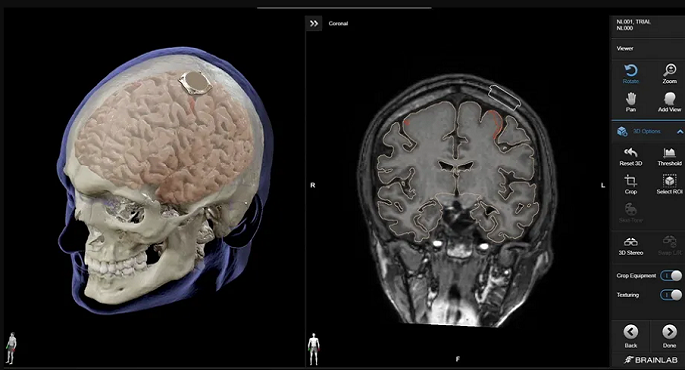 إيلون ماسك يعلن نجاح زرع شريحة دماغية في أول إنسان