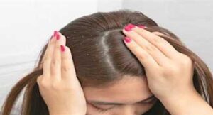 5 زيوت للشعر تزيد من حدة قشرة الرأس
