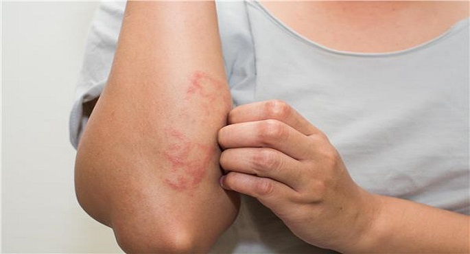 جل الصبار الأبرز.. 4 علاجات منزلية فعالة للأكزيما
