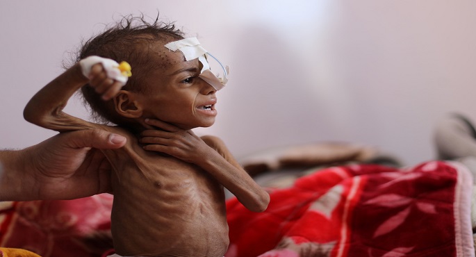 الأمم المتحدة: أكثر من 17 مليون شخص فى اليمن يعانون من الجوع