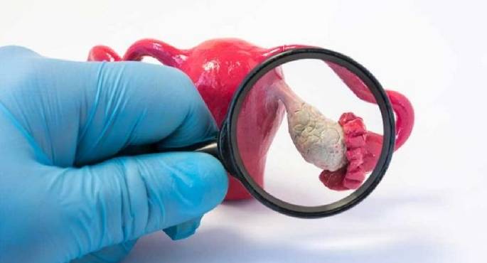 دواء مستخدم لسرطان الرئة يفتح بابًا جديدًا لعلاج سرطان المبيض